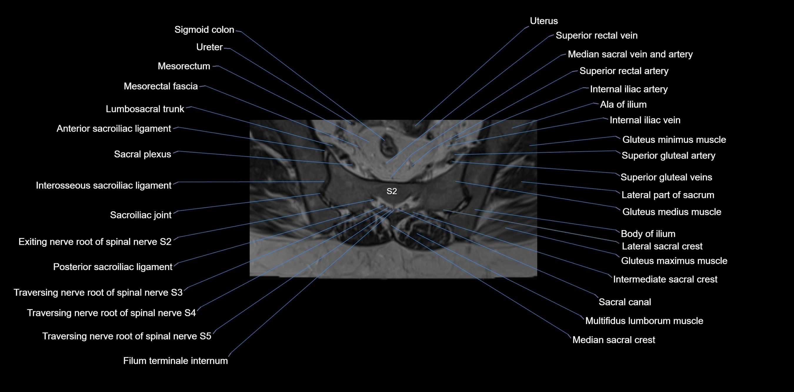 MRI sacrum, coccyx and sacroiliac joint axial cross sectional anatomy 3T  radiology  image-img-00001-00029.webp